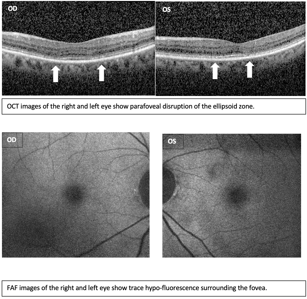 Four images with the caption: OCT images of the right and left eye show parafoveal disruption of the ellipsoid zone - for the two images on top and for the two images underneath, the caption reads: FAF images of the right and left eye show trace hypo-flurescence surrounding the fovea.
